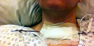 3 Stunden nach der Operation: Hals ohne Schilddrüse mit Pflaster und Schläuchen