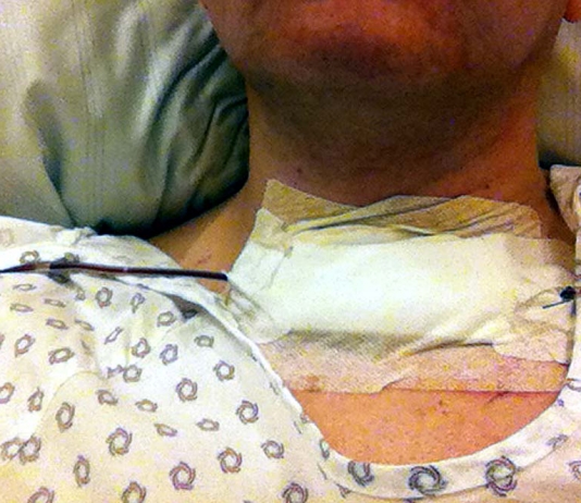 3 Stunden nach der Operation: Hals ohne Schilddrüse mit Pflaster und Schläuchen